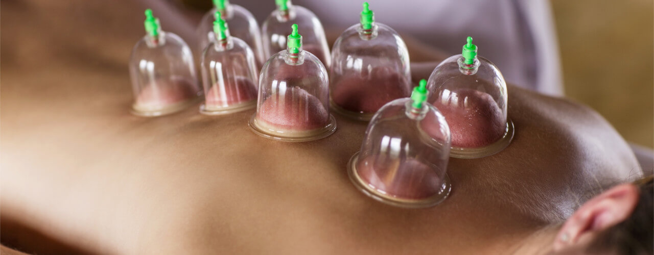 Cupping/Myofascial Decompression