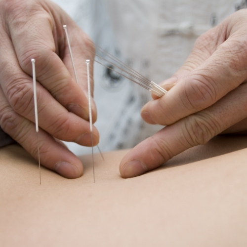 Dry-Needling-The-FItness-Lab-Highlands-Ranch-Parker-Denver-Greenwood-Village-CO