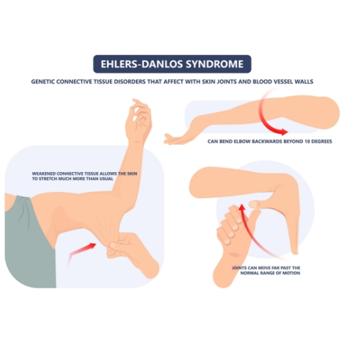 Ehlers-Danlos-Syndrome-EDS-The-FItness-Lab-Highlands-Ranch-Parker-Denver-Greenwood-Village-CO