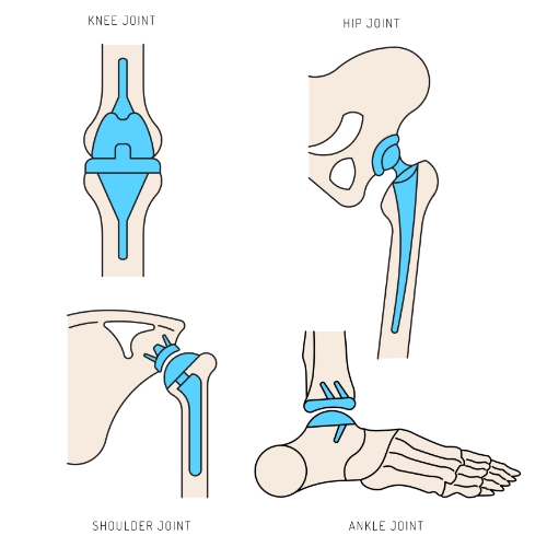 Joint-Replacement-The-FItness-Lab-Highlands-Ranch-Parker-Denver-Greenwood-Village-CO