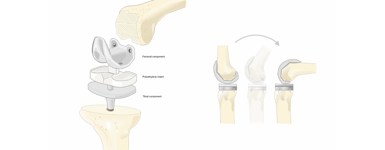 Knee Replacement